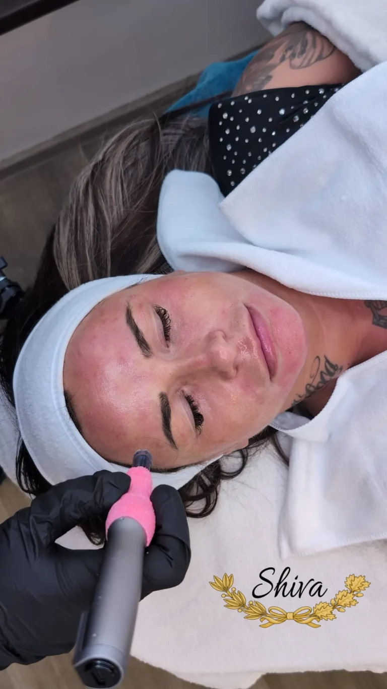 Professionelle Microneedling-Behandlung des Gesichts mit einem Needling-Pen im Kosmetikstudio in Mannheim.